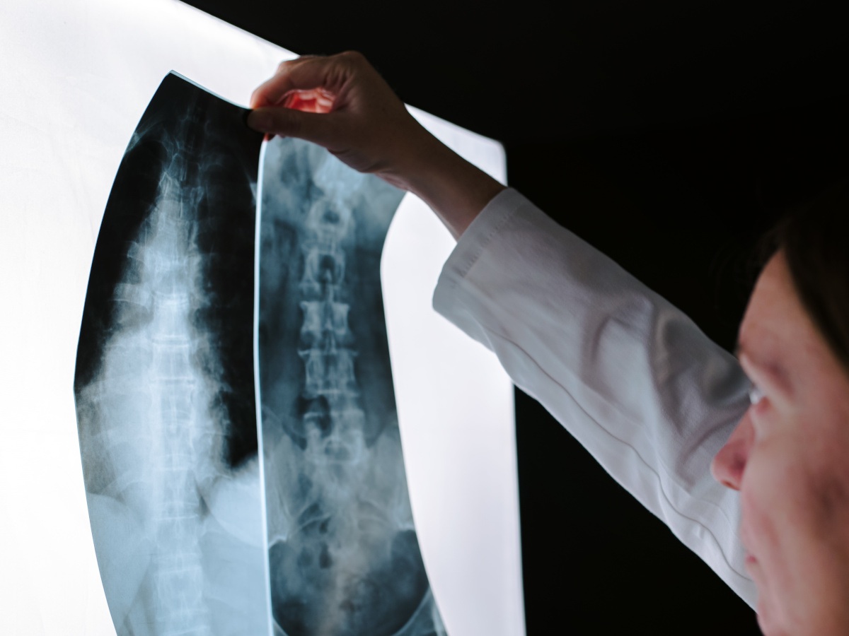 RCSI experts develop 3D implant that stimulates spinal cord healing